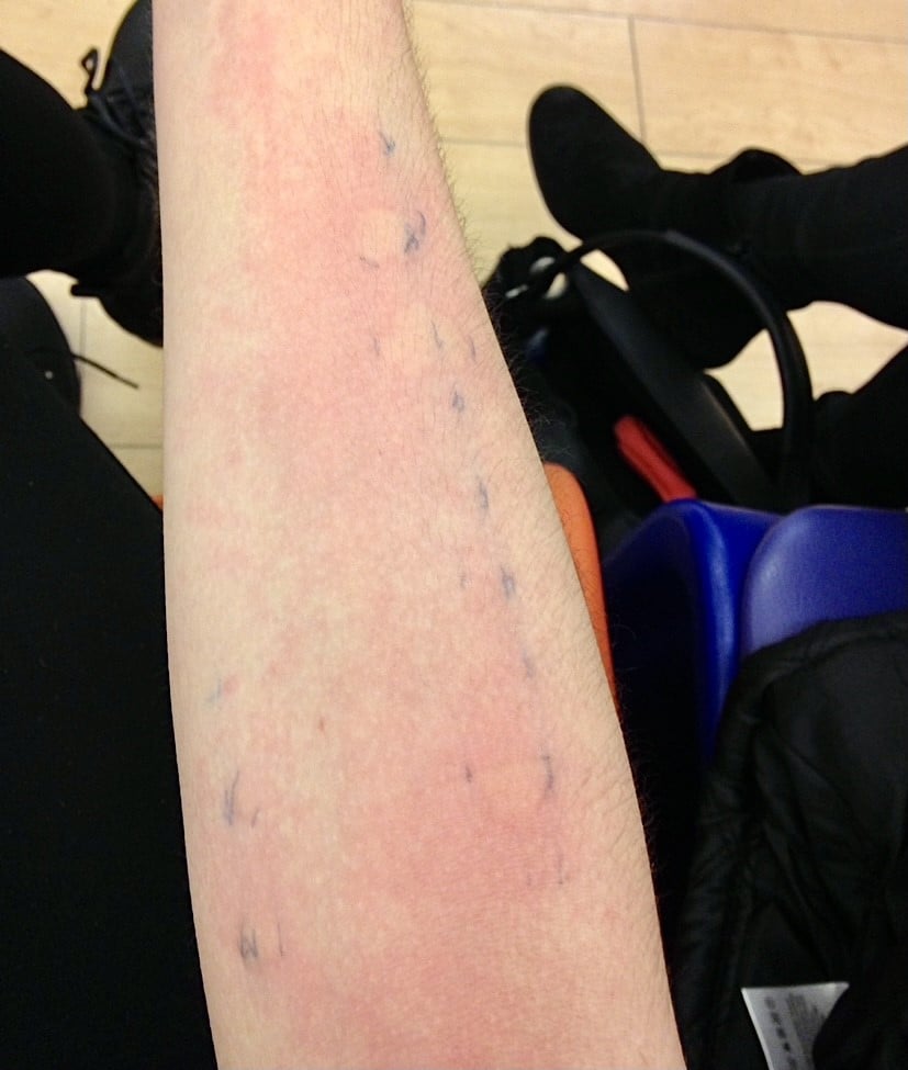 Hannah's allergy prick test